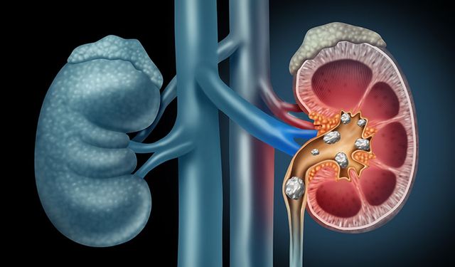 Böbrek taşı erkeklerde daha sık görülüyor